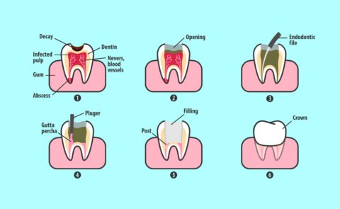 Root Canal Treatment – Endodontic Treatment 